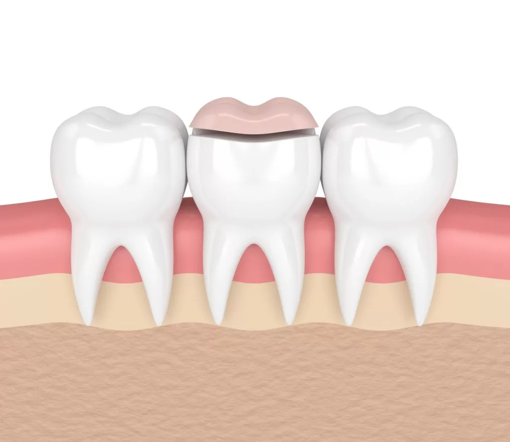 3d rendering of a dental inlay being applied