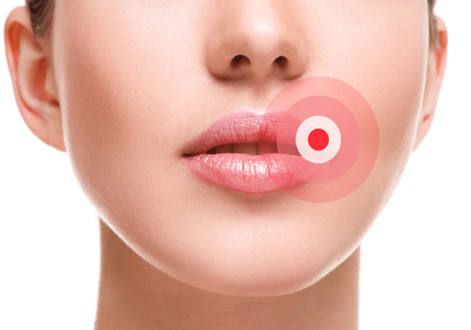 Cold sore treatment available at Erik P. Cadra Dentistry in Valencia, CA