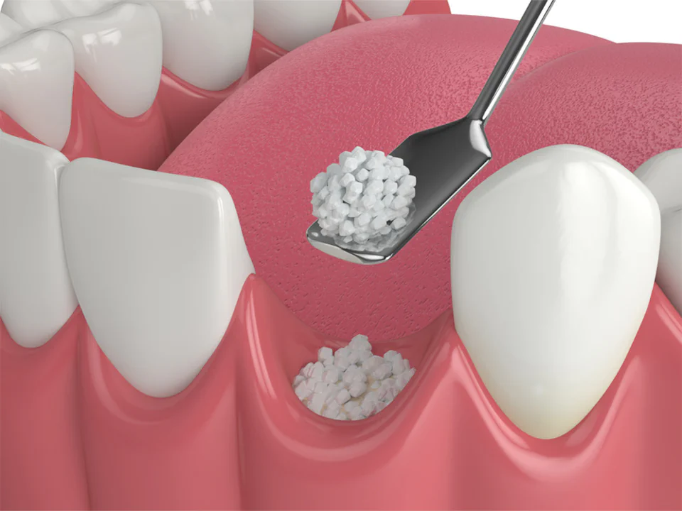Dental bone grafting available at Erik P. Cadra Dentistry in Valencia, CA