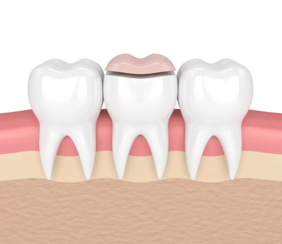 Dental inlays and dental onlays available at Erik P. Cadra Dentistry in Valencia, CA