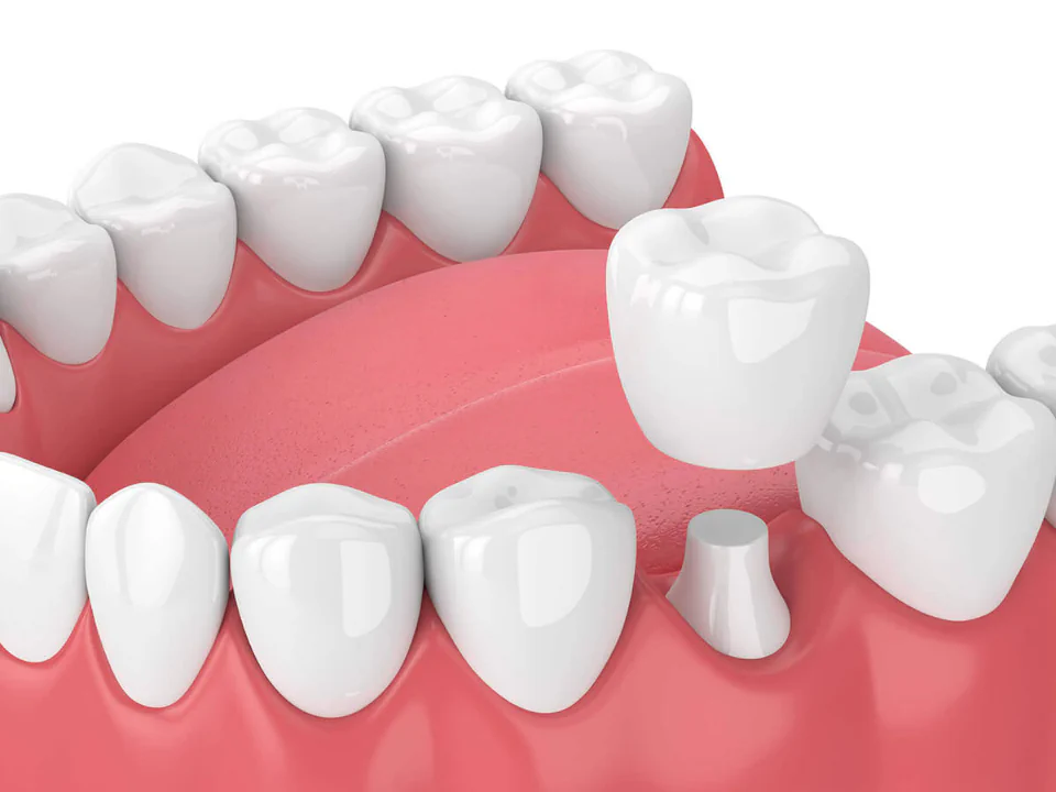 Dental crowns and dental bridges available at Erik P. Cadra Dentistry in Valencia, CA