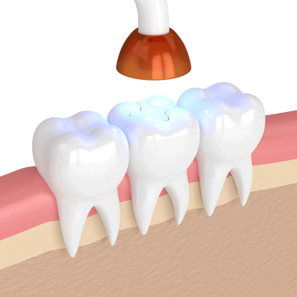 Tooth fillings and tooth sealants available at Erik P. Cadra Dentistry in Valencia, CA